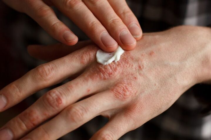 treatment of psoriasis on a child's hands