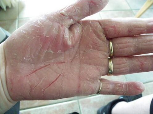 psoriasis on the palm of the hand