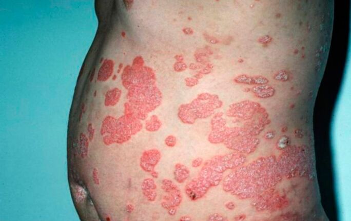 Symptoms of psoriasis in the body