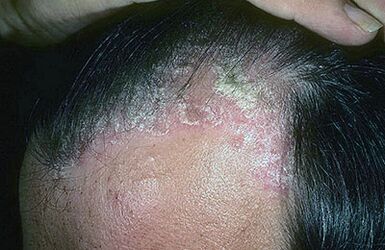 psoriasis picture on the head 1