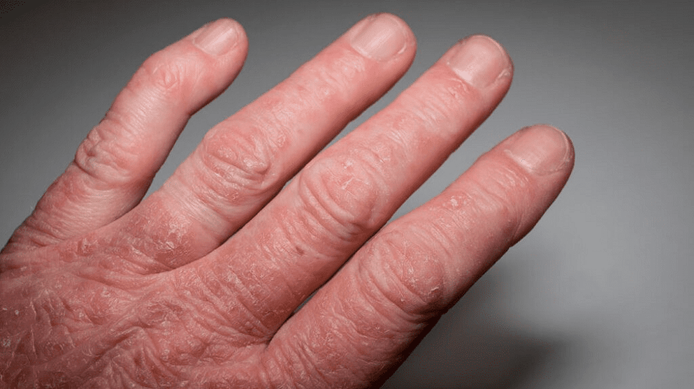 psoriatic arthritis in the hands