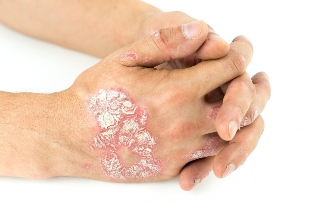 how psoriasis looks on the hands