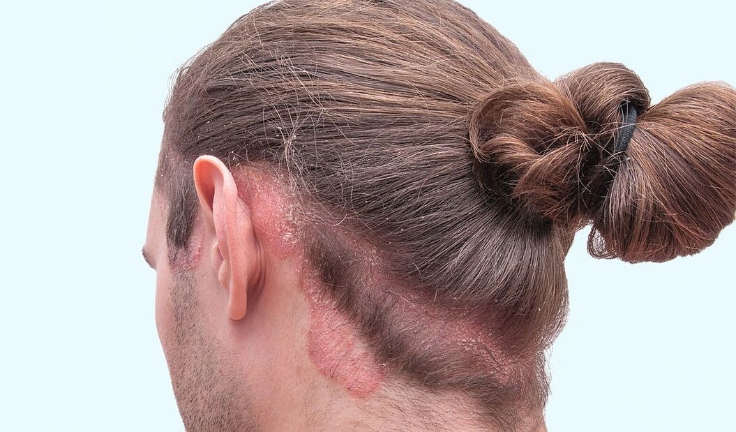 psoriasis of the head