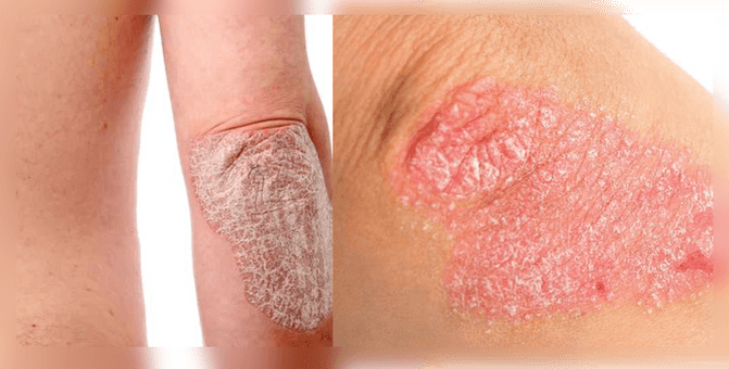 how psoriasis looks on the skin