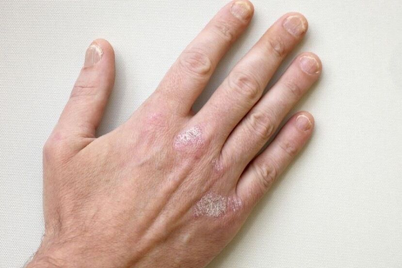 A mandatory symptom of psoriasis is scaly plaques on the skin