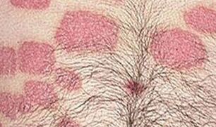 Numerous pink formations in the abdomen