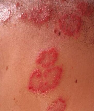 Psoriasis stains