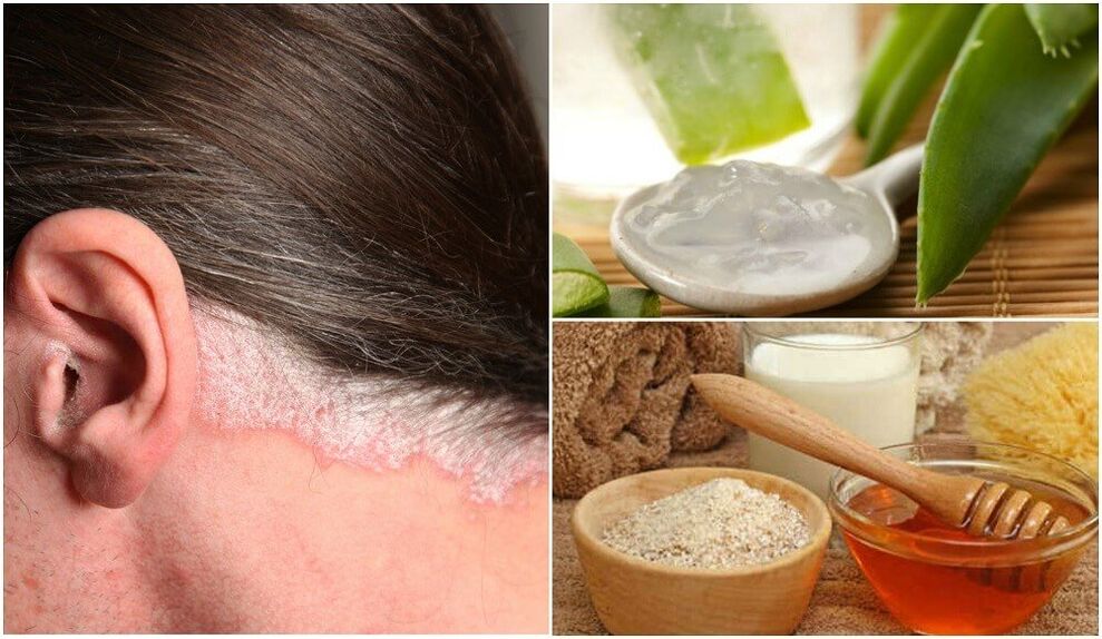 Treating psoriasis with popular remedies