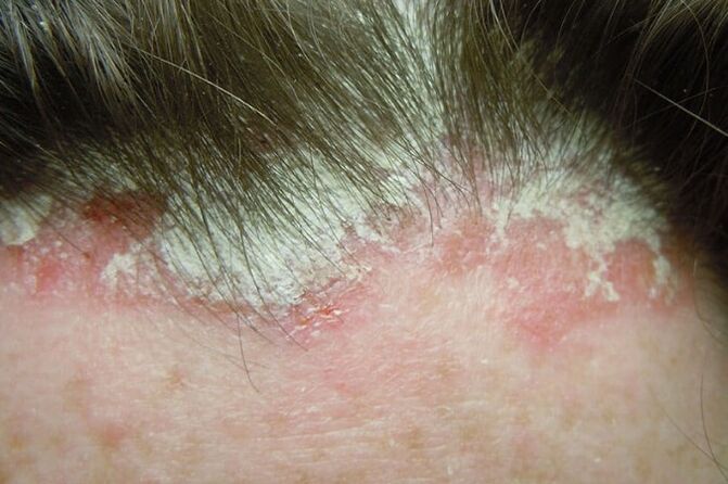 Psoriasis catches the entire scalp hair