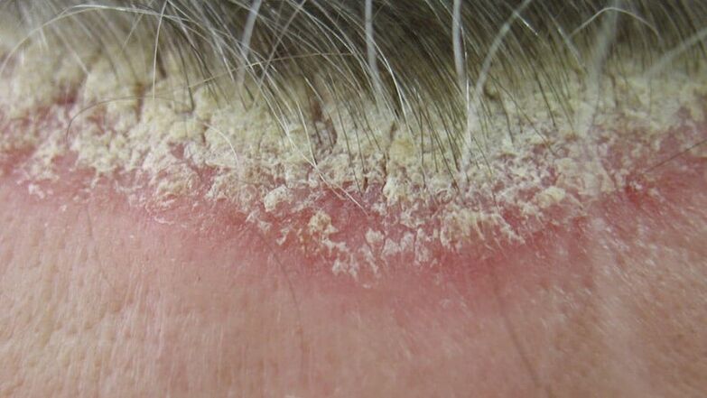 Psoriasis of the head