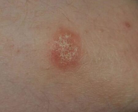 Psoriasis