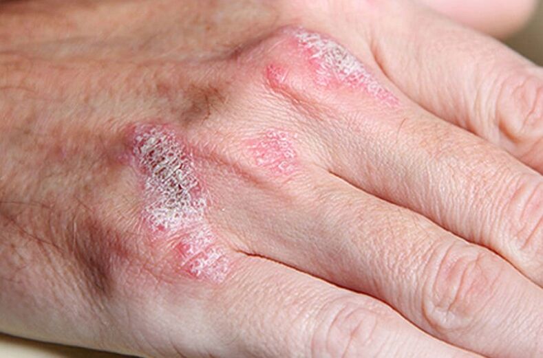 Sustainable psoriasis