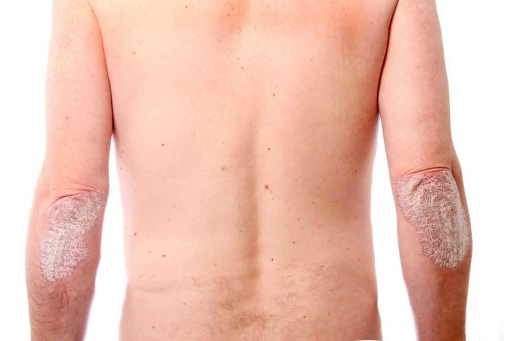 The second stage of psoriasis