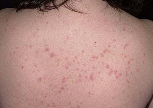 Initial phase of psoriasis