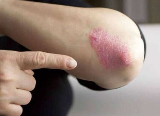 The immovable stage of psoriasis
