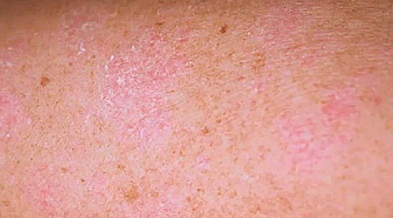 The regressive phase of psoriasis