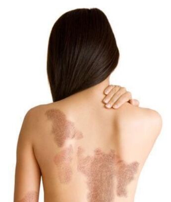 Stages of psoriasis depending on the lesion area