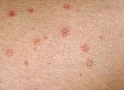 The initial phase psoriasis