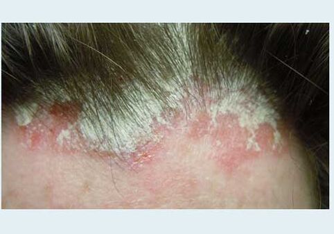 Head injury