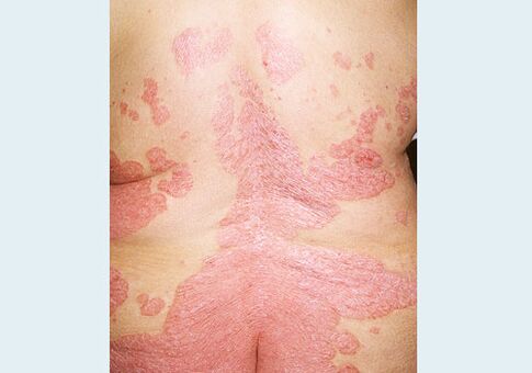Psoriasis of the back