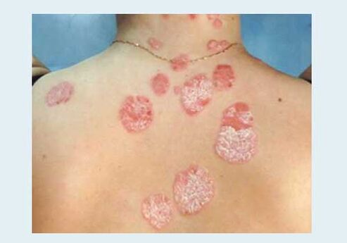 The usual psoriasis