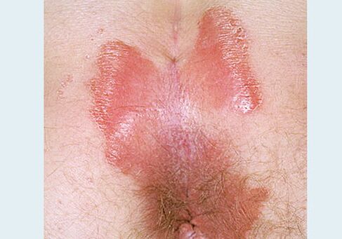 Tight psoriasis -spinning