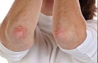Psoriasis in elbows