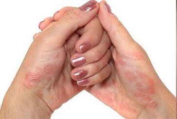 Psoriasis in the hands