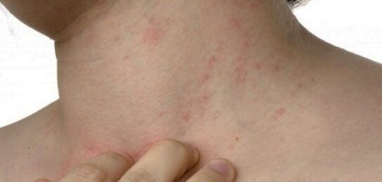Psoriasis in the neck