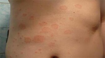 Psoriasis in the stomach