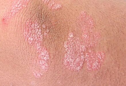 psoriasis