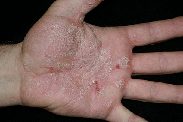 Psoriasis in the hands