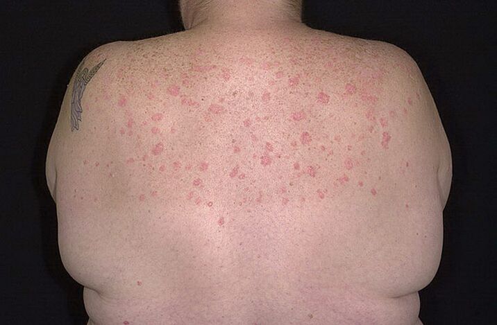 Psoriasis on shoulder