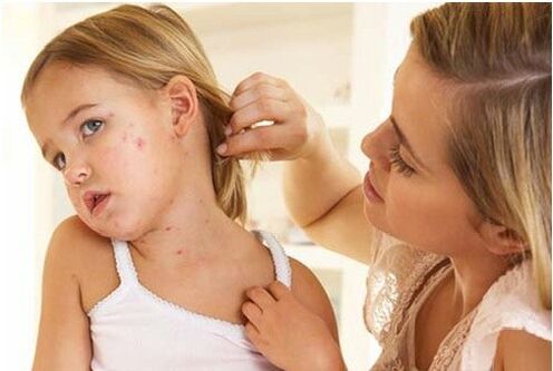 Photo of the initial phase of psoriasis