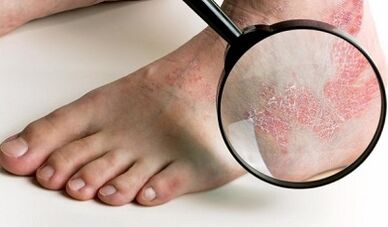 Psoriasis treatment options