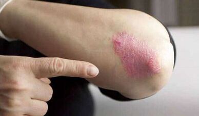 The stationary stage of the development of psoriasis