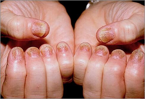 Psoriasis of the nails