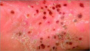 Pustular psoriasis