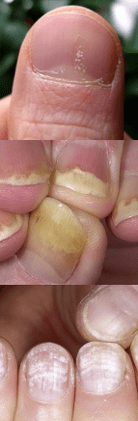 Psoriasis of nails - initial phase