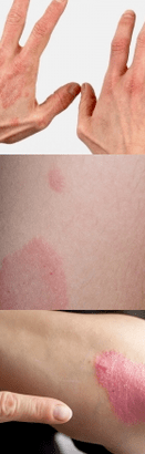 Psoriasis of the initial phase in the hands