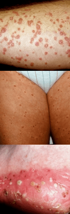 Psoriasis standing