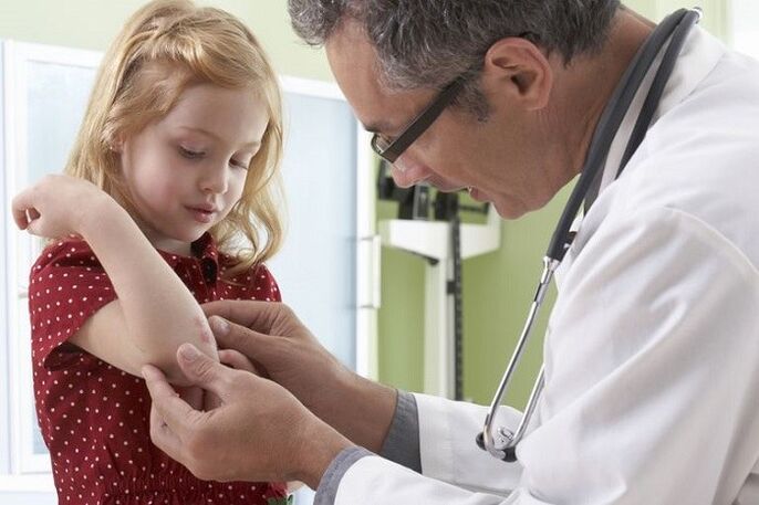 psoriasis at a young age