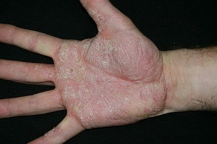 psoriasis of the palms and soles