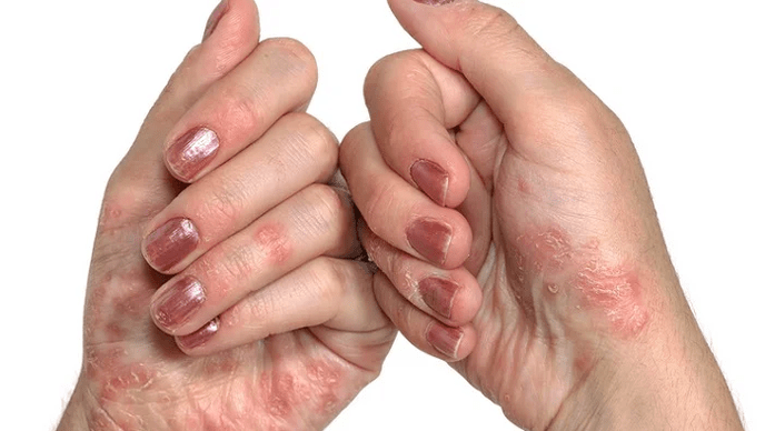 Initial phase of psoriasis
