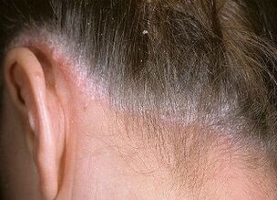 causes of psoriasis on the head