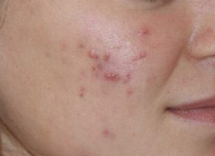 Psoriasis of the face
