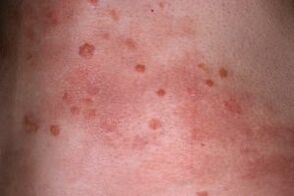 picture of psoriasis on the skin