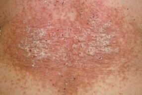 the social phase of psoriasis