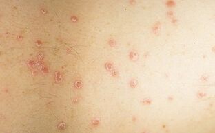 picture of the initial stage of psoriasis